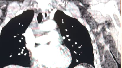 Breast Saved Against All Odds Thanks to Tumor Board Collaboration on Invasive, Aggressive Tumor