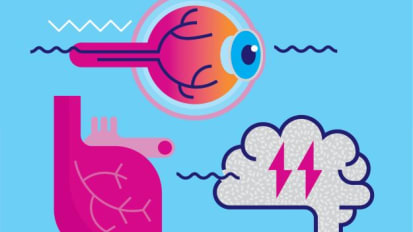 Two Distinct Pathways Are Identified for Age-Related Macular Degeneration