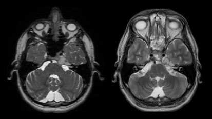 Positive Patient Outcomes With Minimally Invasive Skull Base Surgery: UCSF Case Studies