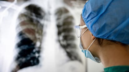 UCSF Health Reaches Lung Transplant Milestone