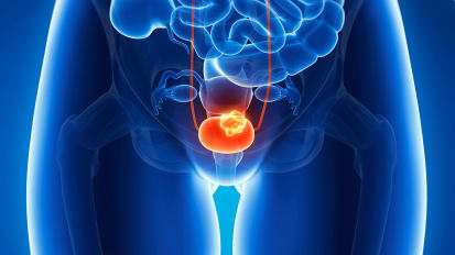 UCSF Urology Clinicians Present Research Findings at SurgeWest