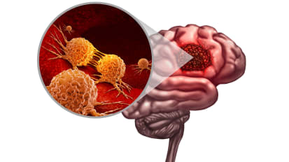 New Research Illuminates How Ultrasound Could Be Used in Fight Against Glioblastoma and Other Brain Conditions