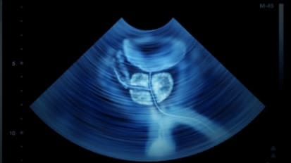 Mount Sinai Begins Offering High-Intensity Focused Ultrasound (HIFU) for Localized Prostate Tumors