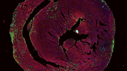 Uncovering Why Cancer Immunotherapy Leads to Heart Inflammation