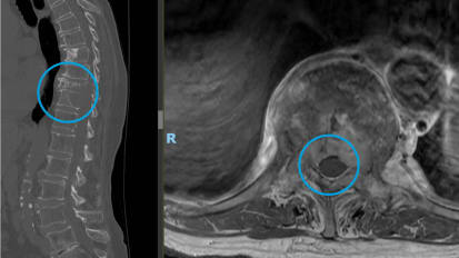 Performing a Minimally Invasive Approach for Spinal Tumor Resection