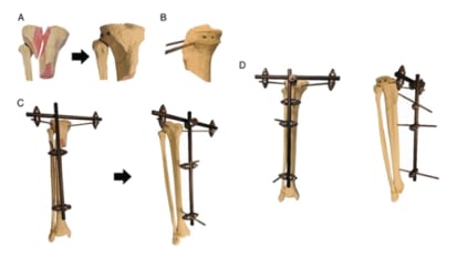 Novel T-bar technique for tibia fractures reduces infection risk and promotes bone healing