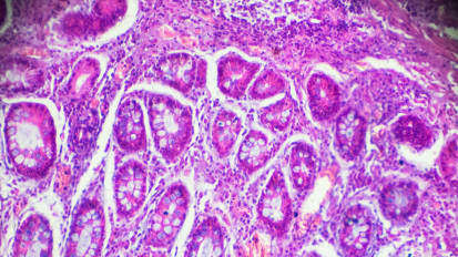 Comparison of CDH1 Penetrance Estimates in Clinically Ascertained Families vs Families Ascertained for Multiple Gastric Cancers