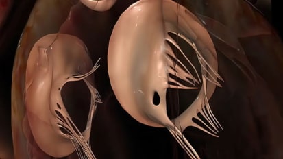 Partial Heart Transplant Delivers Durable, Growing Valves for Repair of Critical Congenital Heart Defects