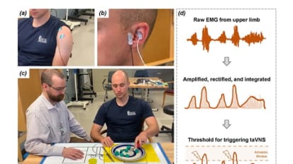 Vagus Nerve Stimulation