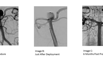 Emory Neurosurgery First in Southeast to Use WEB<sup>®</sup> Device to Treat Aneurysm