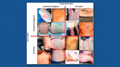 Research Story Tip: AI and Deep Learning Can Analyze ‘Rash Selfies’ for Better Lyme Disease Detection