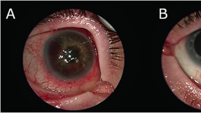 Dementia and Panuveitis: A Case of Whipple Disease