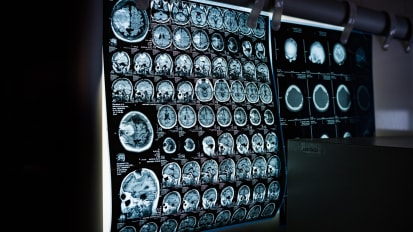 Breaking New Ground: Exploring the Link Between Brain Function and Systemic Metabolism in Alzheimer’s Disease