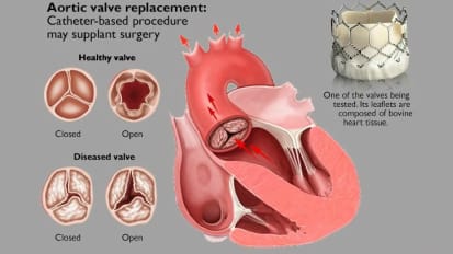 Data Suggests Thousands of Heart Patients Can Avert Surgery