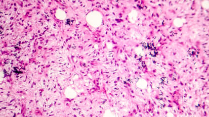 Retroperitoneal Sarcoma with Dr. Karakousis
