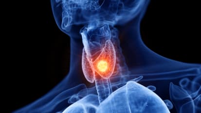 CAR-T Trial for Medullary Thyroid Cancer