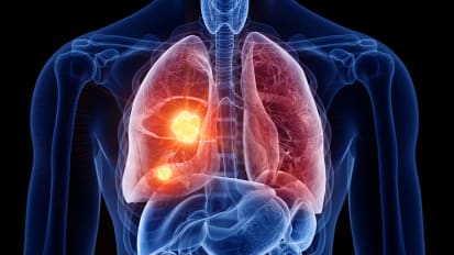 Advances in Lung Cancer Treatment: Navigating Toward a Solution