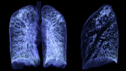 Lung Cancer Awareness Month: Vital Importance of Lung Cancer Screenings