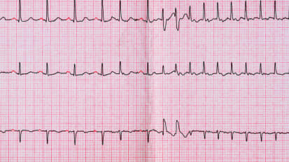 AFib, Episode 2: The Ablation Era