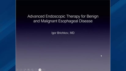 The Oncology Brief: A Monthly CME Series by The Statesir Cancer Center - New Endoscopic Treatments for Benign and Malignant Esophageal Disease