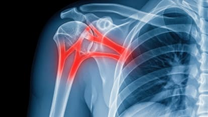 Treatment of Rotator Cuff Pathology: From PT to Shoulder Replacement
