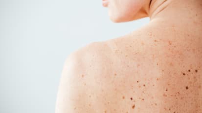 Surveillance and Screening of Adults with Neurofibromatosis Type 1 (.25)