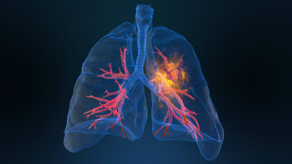 The Benefits of Early Lung Cancer Screening: A Thoracic Surgeon’s Perspective on Early Detection and Collaborative Care