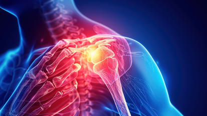 Shoulder Instability, my Approach to Diagnosis and Treatment