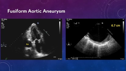 Breaking Down Updated Aortic Guidelines for Echocardiographers