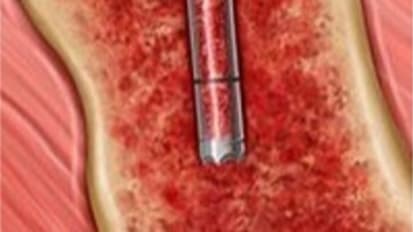 Bone Marrow aspiration and Biopsy with the BD Trek™ Bone Marrow System