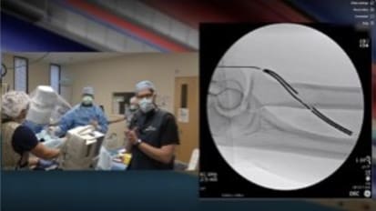 WLQRES2 -Moderated WavelinQ™ EndoAVF System Procedure