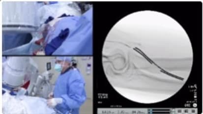 WLQRES3 - WavelinQ™ EndoAVF Procedure Library