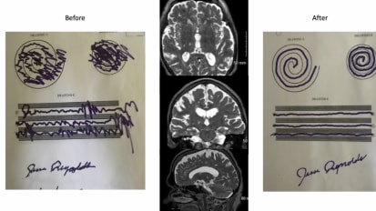 High Intensity Focused Ultrasound (HIFU) & Essential Tremor