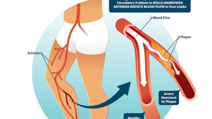 Step Ahead: Multidiscipliplinary peripheral arterial disease seminars for improved health outcomes and quality of life