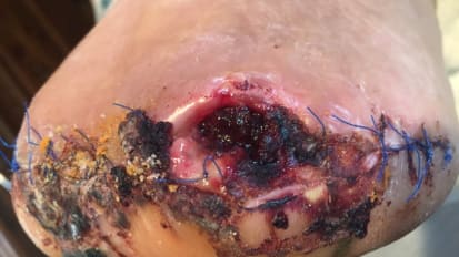 Walking Through Care and Management of Diabetic Foot Ulcers