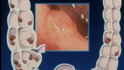 Colon (including Inflammatory Bowel Disease), TPN/Nutrition