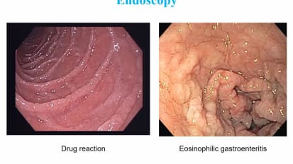 Upper GI (Esophagus, Stomach and Duodenum), Statistics