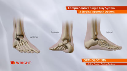 ORTHOLOC™ 3Di Ankle Fusion Plating System Animation [009112]