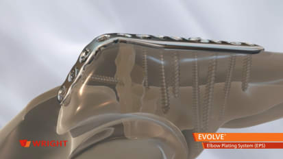 EVOLVE™ Elbow Plating System (EPS) Animation [009134]