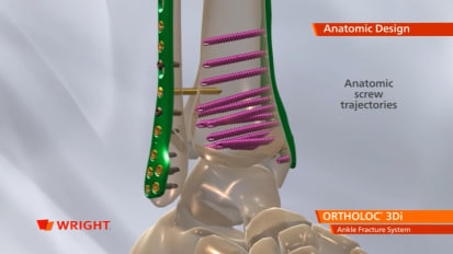 ORTHOLOC™ 3Di Ankle Fracture System Animation [009271]