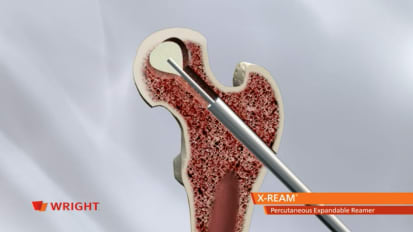 X-REAM® Percutaneous Expandable Reamer Advanced Core Decompression Animation [009272]
