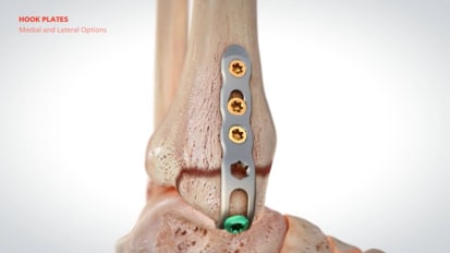 ORTHOLOC™ 3Di Ankle Fracture LP System Animation [015666]