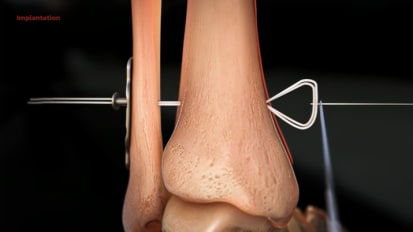 GRAVITY™ SYNCHFIX™ Bone-Sparing Technique Animation [015700]