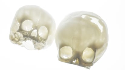 Surgical Correction of Non-Syndromic Craniosynostosis