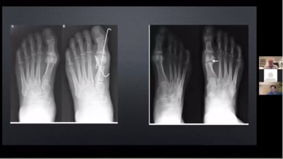 PROstep™ MIS: An introduction to modern day MIS for forefoot surgery [AP-013711]