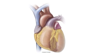 Cardiovascular Medicine webinar — Reperfusion therapy for STEMI: A case for the pharmacoinvasive approach even in the USA