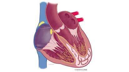 Cardiovascular Medicine webinar — Mechanical complications in patients with mechanisms of acute myocardial infarction (AMI)