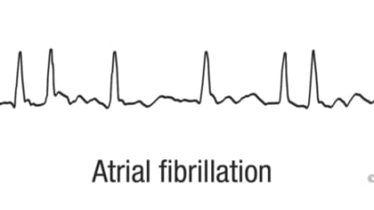 Heart Rhythm Webinar Series: Challenging case discussion with Mayo Clinic experts on atrial fibrillation