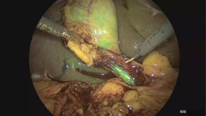 IMAGE1 S™ Rubina™ Laparoscopic Cholecystectomy