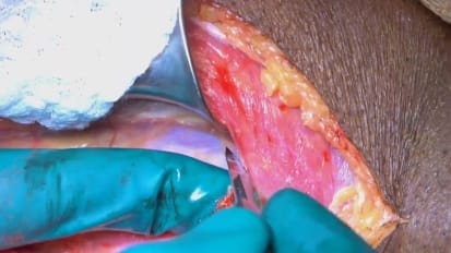 Mount Sinai Otolaryngology Surgical Series: Anterolateral Thigh (ALT) Free Flap Harvest